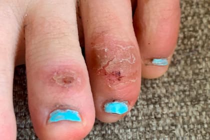 La humedad en los pies, un factor clave para el desarrollo de infecciones fúngicas comunes como la tiña