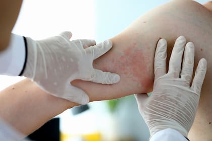 Dermatitis atópica