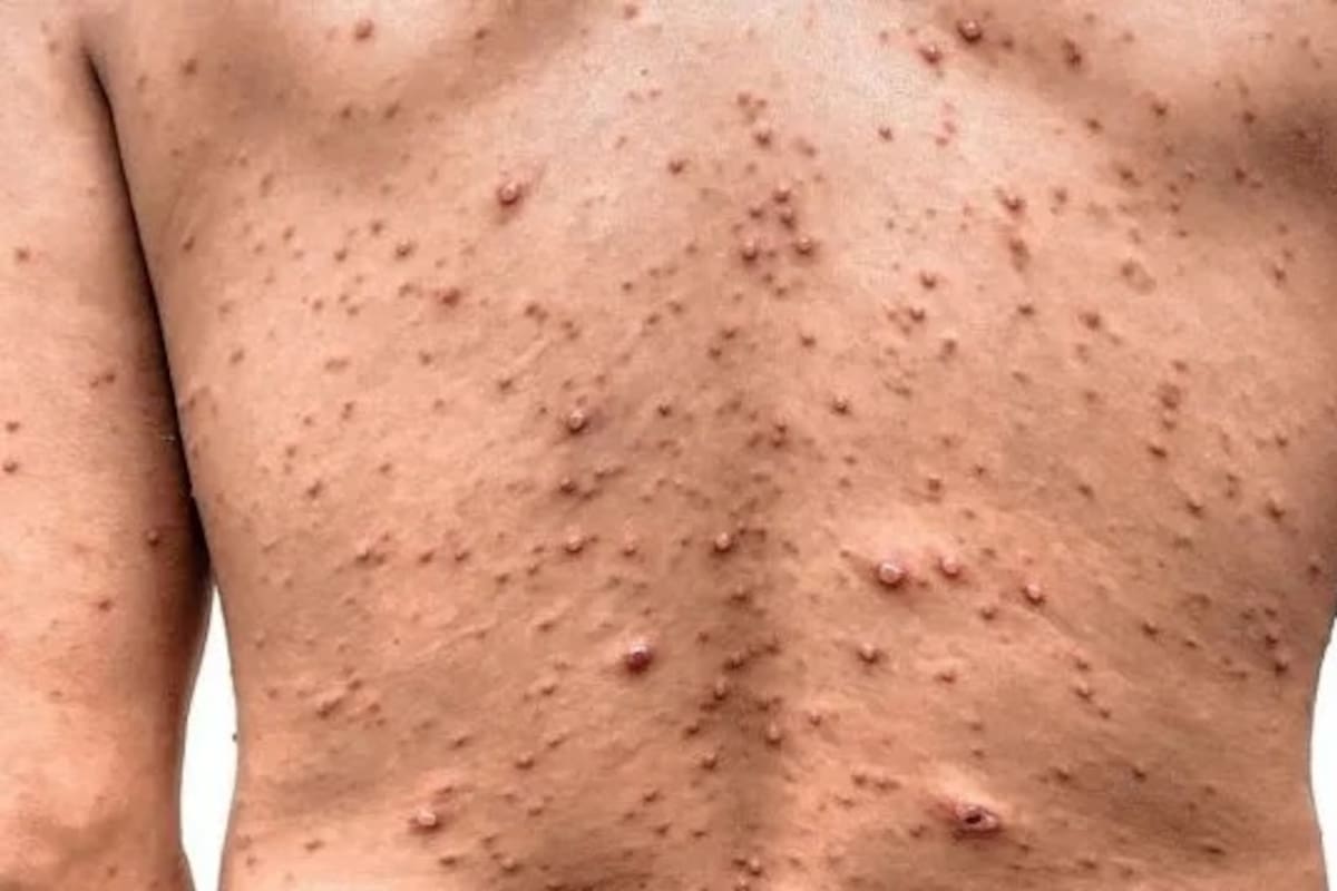 Desde 2015, la vacuna contra la varicela forma parte del Calendario Nacional de Vacunación