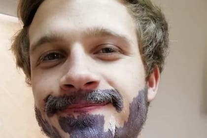 Después de que su novia lo convenciera, Marno Botha se tiñó la barba y terminó con una grave reacción alérgica