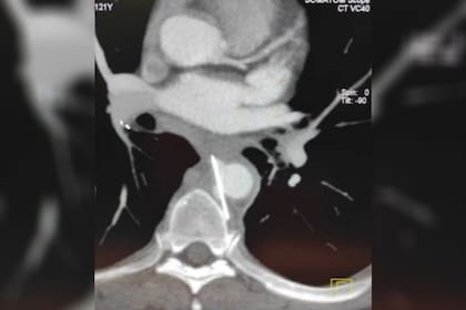 Detectaron la presencia de una aguja de más de tres centímetros en el cuerpo del hombre gracias a una tomografía computada