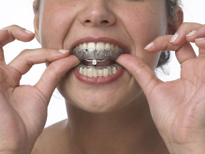 Dispositivo de Avance Mandibular. Foto: Clínica BioSmile.