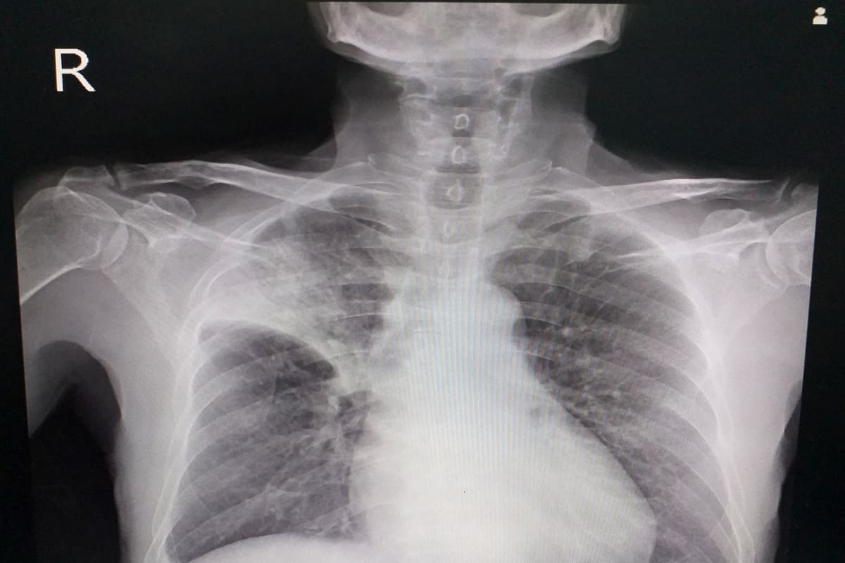 Dos años después de ser operado de una válvula del corazón se sometió a una nueva intervención quirúrgica ante la sospecha de un tumor y encontraron una compresa de gasa de 30 centímetros