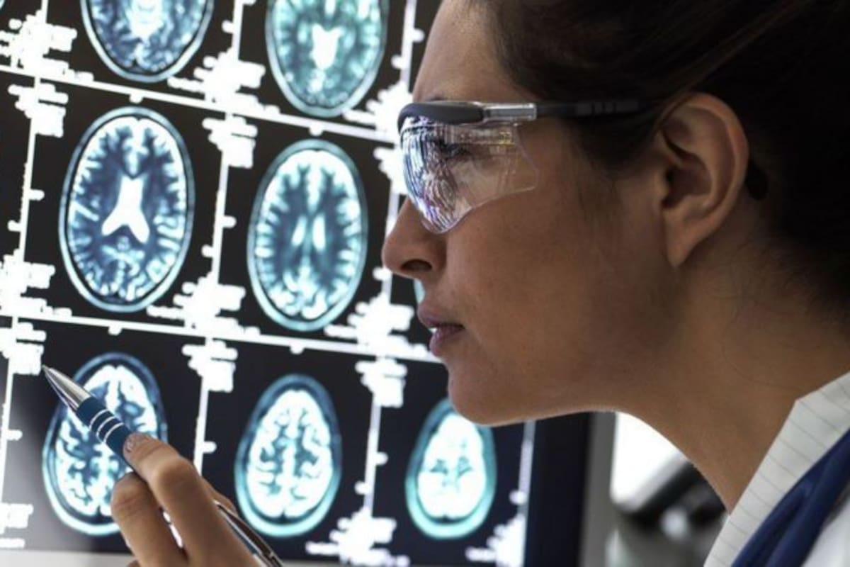 Dos nuevos fármacos mostraron una reducción en el deterioro cognitivo que causa la enfermedad de Alzhemeir