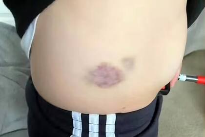 Durante la autopsia, el Dr. Dante Ragassa encontró una incalculable cantidad de moretones en el cuerpo del pequeño oriundo de Nueva Jersey