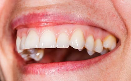 Durante la evaluación en el consultorio, el odontólogo examina los dientes y las encías, recopila información sobre los hábitos de higiene, la alimentación y el historial farmacológico del paciente
