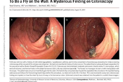 Durante la revisión de rutina del colon de un hombre, se descubrió a una mosca que se había alojado en la pared intestinal