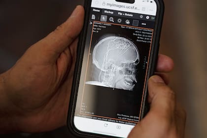 Una tomografía computarizada que muestra los cables en el cerebro de Mowery