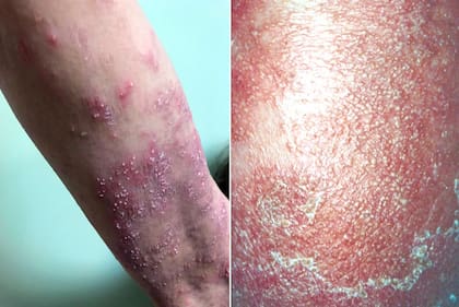 Ejemplos de psoriasis pustulosa generalizada