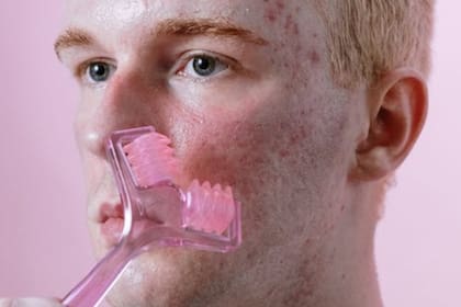 El acné puede tratarse mediante la alimentación (Foto Pexels)