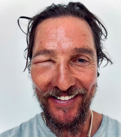 El actor estadounidense sufrió una picadura de abeja que le provocó una reacción alérgica