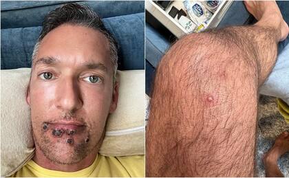 El actor Silver Steele relató en Twitter el calvario que sufrió tras contraer la viruela del mono