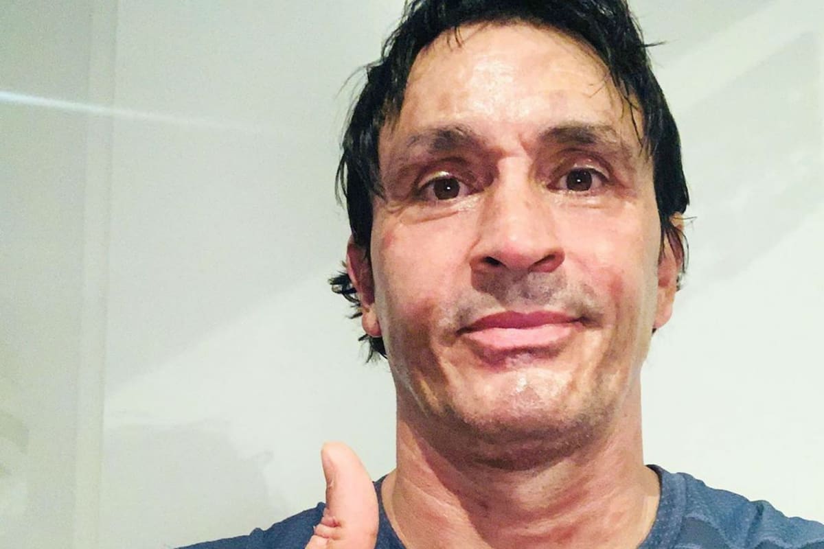 El actor sufrió serias quemaduras en su cara, cuello y manos.