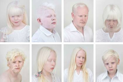 El albinismo altera la pigmentación en la piel, el cabello o los ojos. Fuente: Jorge Mónaco