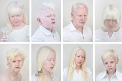 El albinismo altera la pigmentación en la piel, el cabello o los ojos