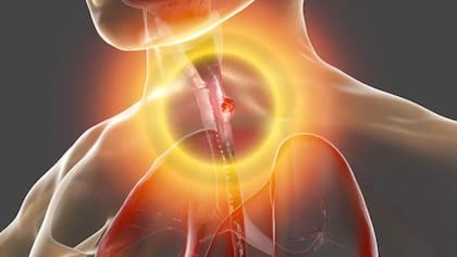 El alcohol hace que los músculos del cuerpo se relajen, incluida la válvula muscular que separa el estómago del esófago