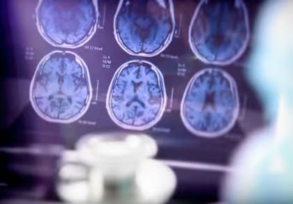 El alzheimer es una enfermedad neurodegenerativa progresiva que destruye la memoria y las habilidades cognitivas.