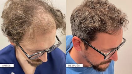 El antes y el después de un microtrasplante capilar pelo por pelo, con resultados sumamente naturales.