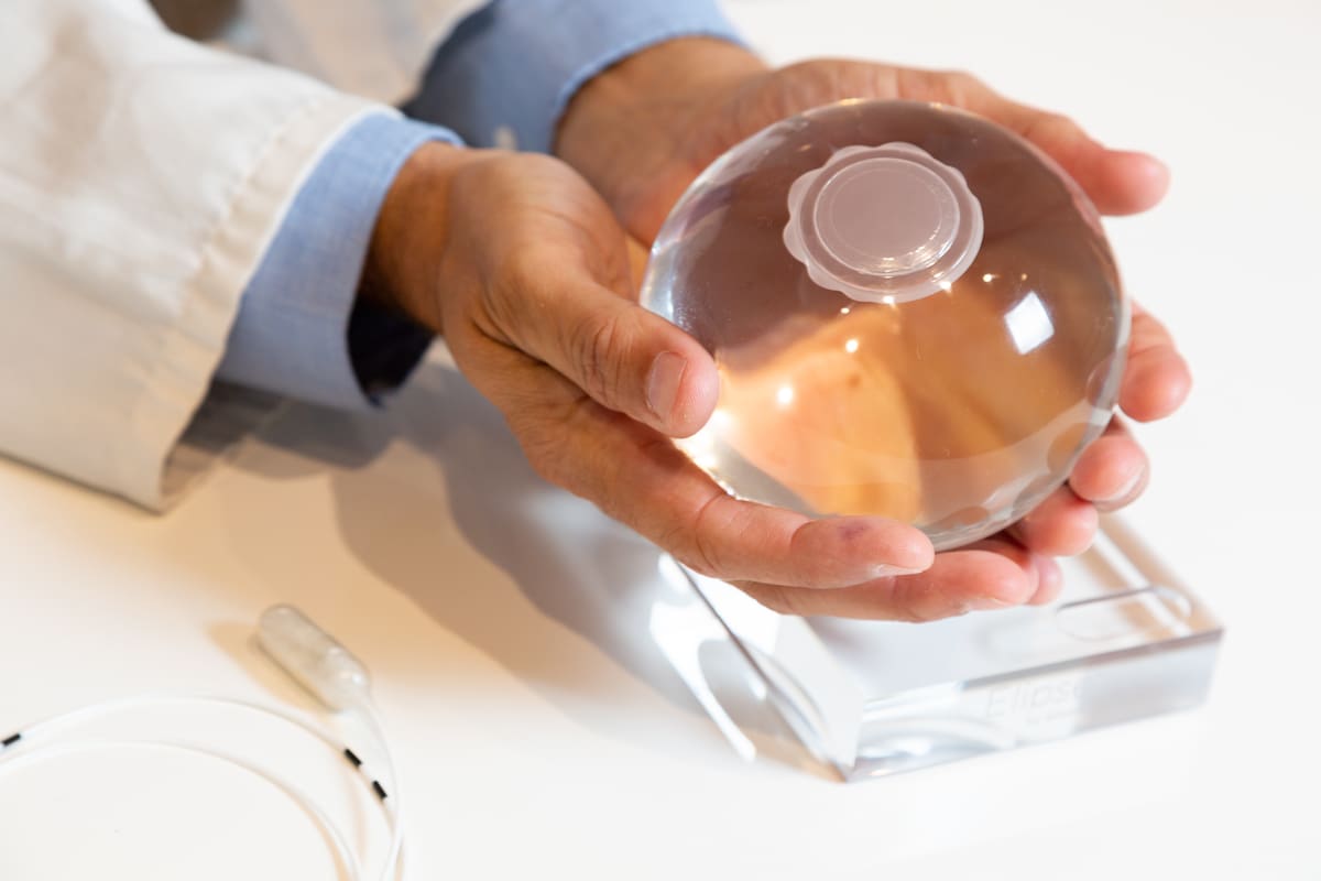 El balón de Allurion ocupa casi el 80% del estómago.