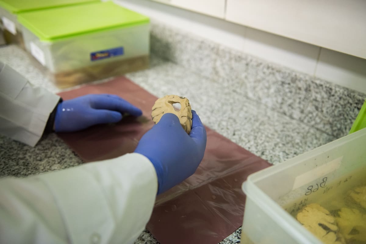 El banco de cerebros del Fleni