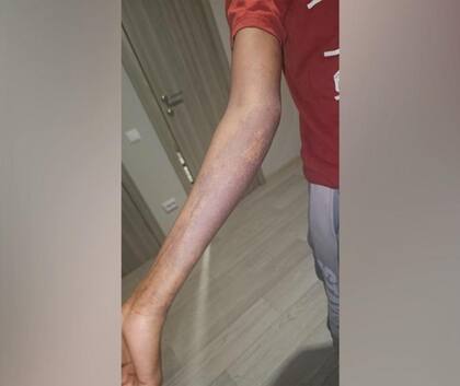 El brazo de un colega de Adau quemado por sustancias químicas.