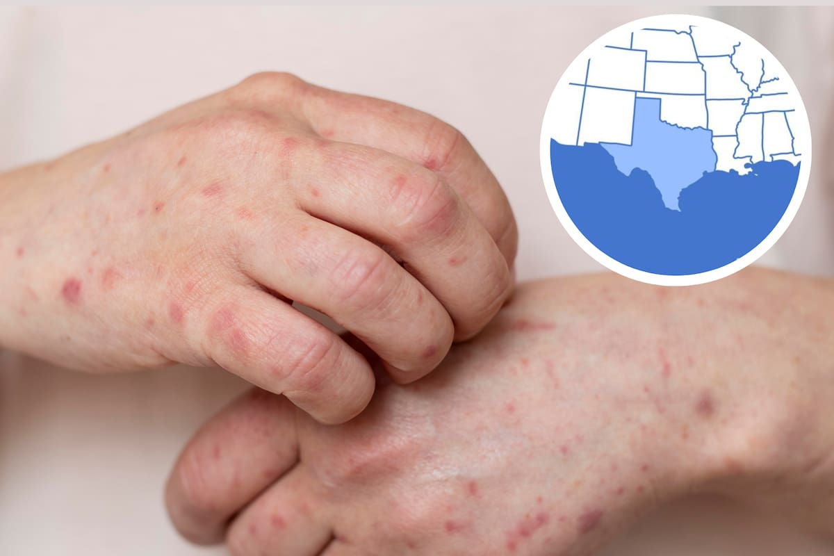 El brote afecta principalmente a una comunidad menonita con baja tasa de vacunación