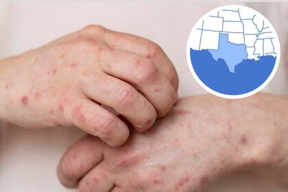 El brote afecta principalmente a una comunidad menonita con baja tasa de vacunación