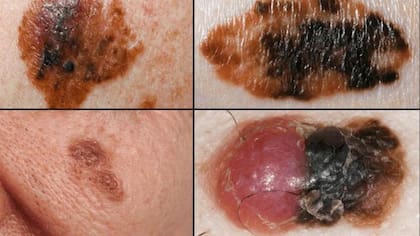 El cambio de aspecto de un lunar, como en estas cuatro imágenes, puede ser un signo de melanoma