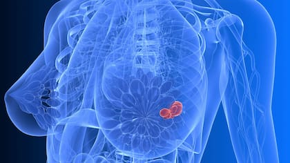 Los principales síntomas del cáncer de mama