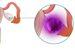 “Cáncer de ovario es un nombre inapropiado": el hallazgo que podría salvar vidas con una cirugía de cinco minutos