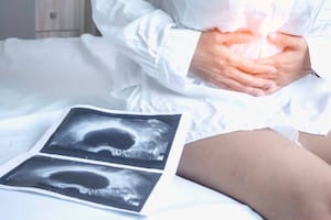 El cáncer de ovario suele diagnosticarse en estadios avanzados, en parte por la ausencia de síntomas específicos en las primeras etapas