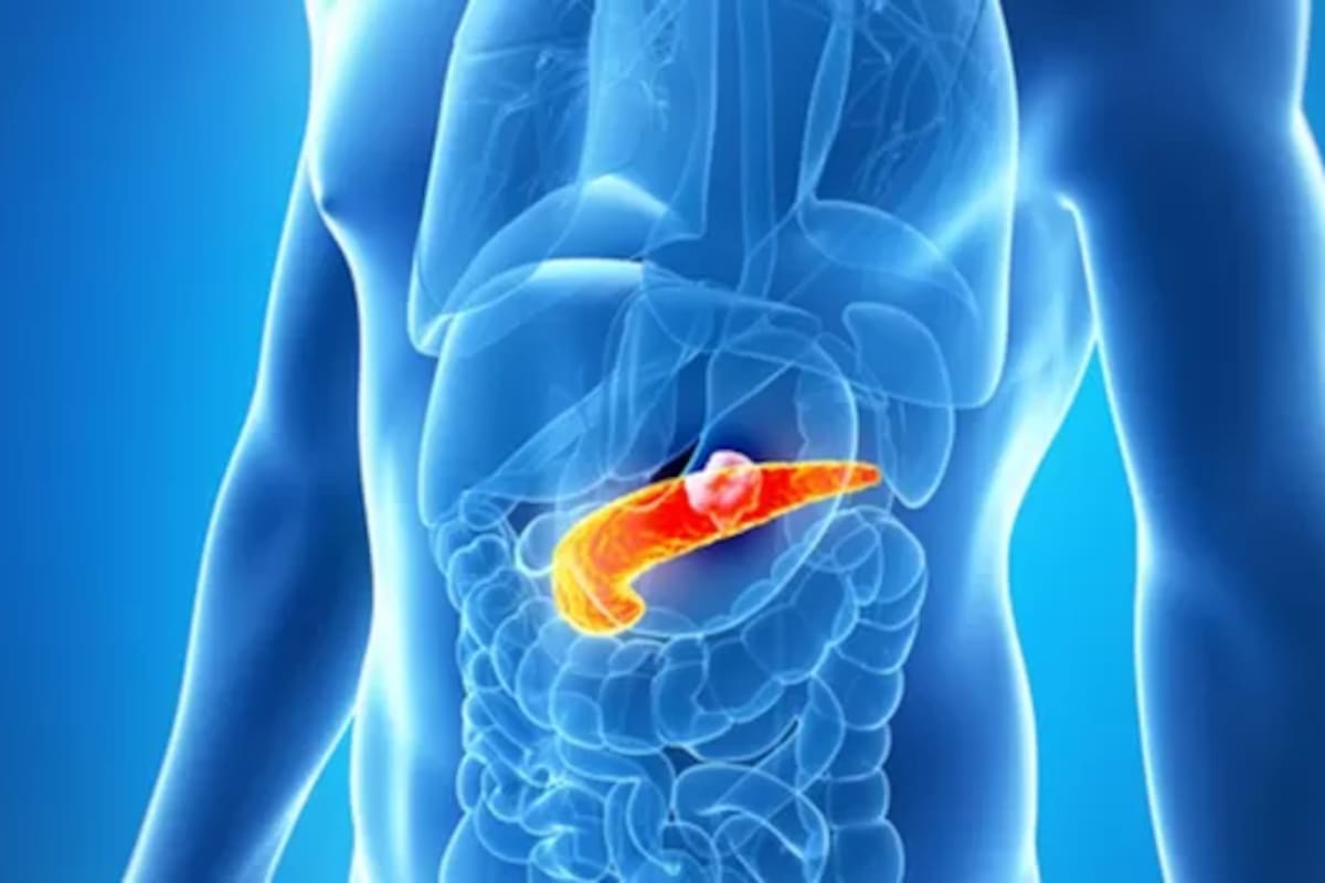 El cáncer de páncreas es de los más agresivos