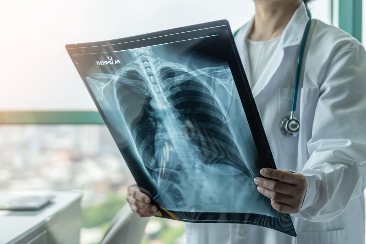 El cáncer de pulmón es el tipo más común