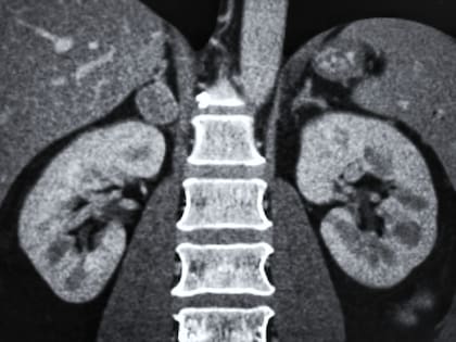 El cáncer de riñón es el quinto más frecuente en la Argentina