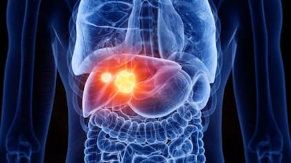 El cáncer de vesícula biliar muestra una incidencia especialmente alta en el norte argentino, donde muchas mujeres son diagnosticadas en etapas avanzadas