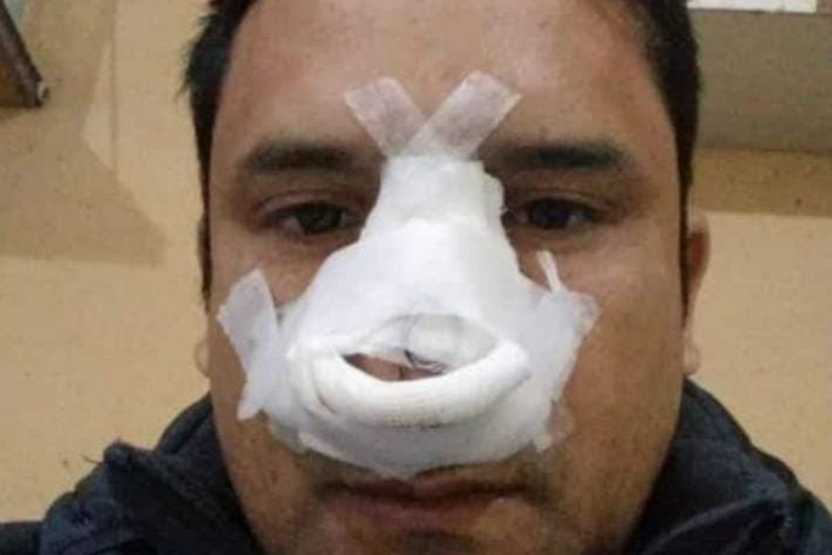 El chofer debió ser operado y se encuentra en reposo a raíz del golpe