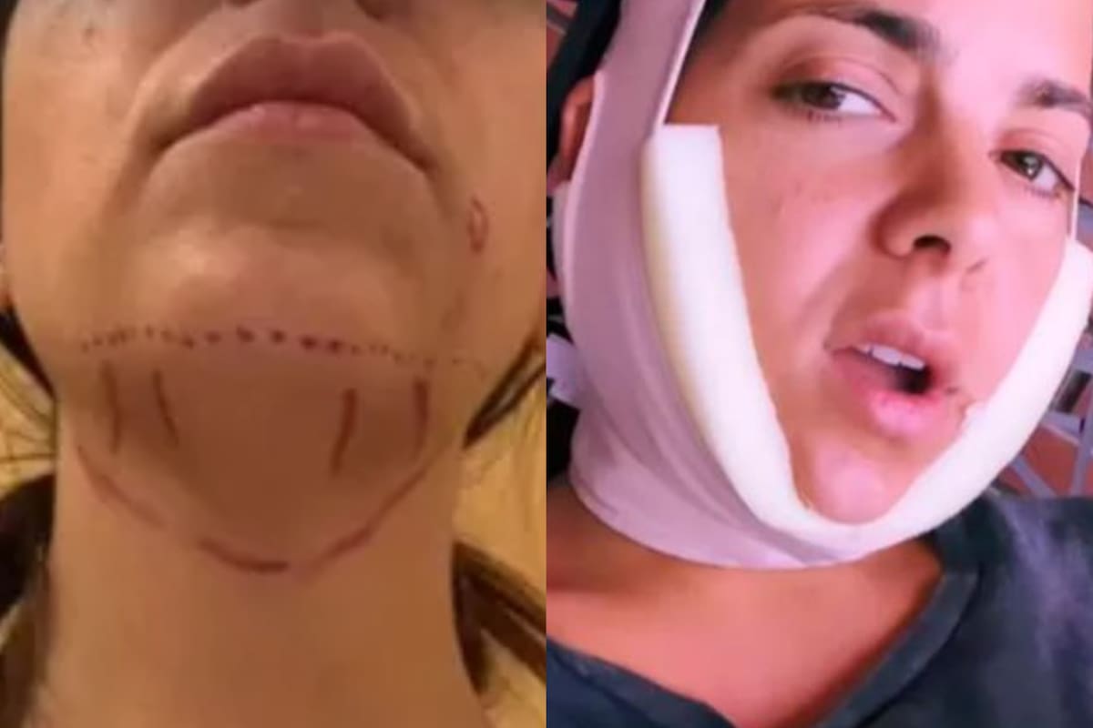 El cirujano plástico dio detalles sobre la intervención estética que se realizó Belu Lucius