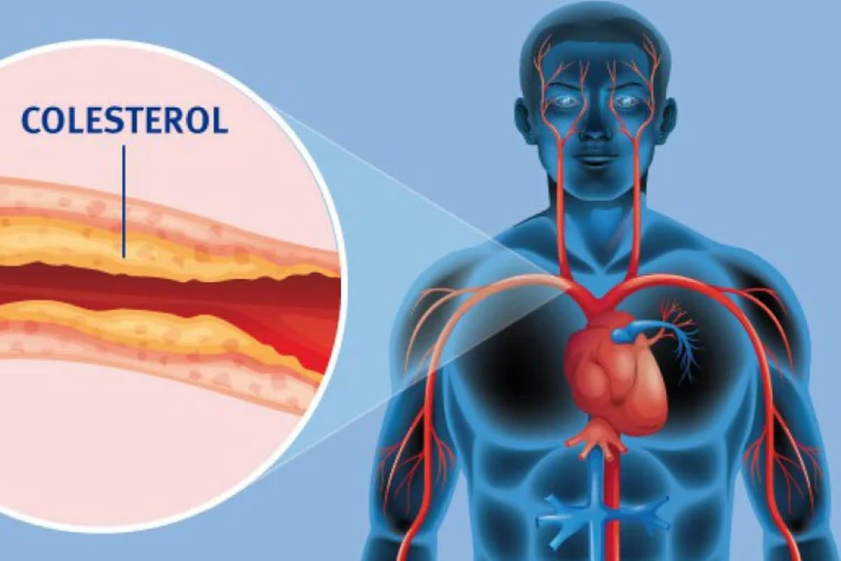El colesterol LDL se acumula en las paredes de las arterias y aumenta el riesgo de enfermedades cardiovasculares, como infartos y accidentes cerebrovasculares