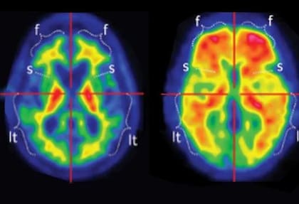 El cuerpo envía advertencias para alertar que algo no anda bien en el cerebro