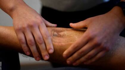 El daño en los nervios le hizo perder la sensibilidad en la pierna izquierda por debajo de la rodilla