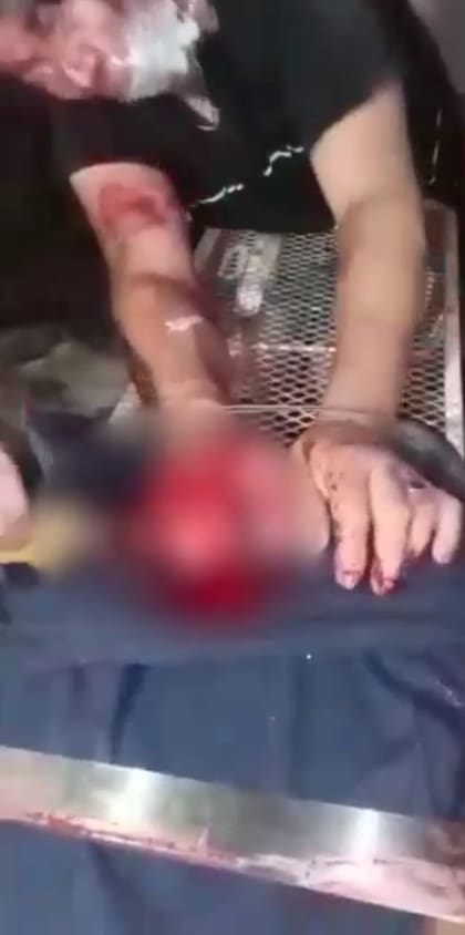 El dealer al que le cortaron las falanges con un machete a modo de escarmiento por haber robado droga de una banda