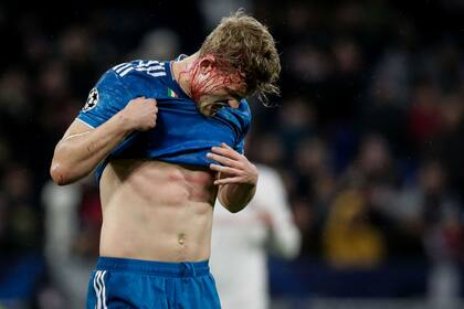 El defensor de Juventus Matthijs de Ligt se retiró ensangrentado del campo de juego tras ser pisado por su compañero Alex Sandro.