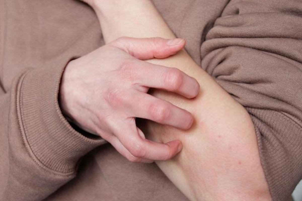 El dengue puede generar un sarpullido cuya comezón es tratable