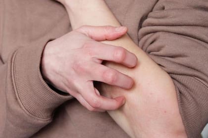 El dengue puede generar un sarpullido cuya comezón es tratable