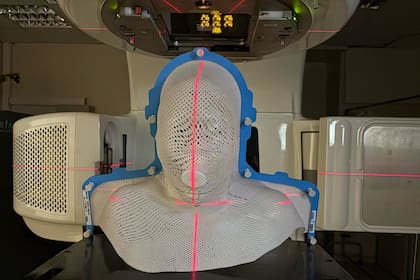 El depresor de lengua se fija a la malla termoplástica durante la preparación de la máscara inmovilizadora que usará el paciente en cada sesión