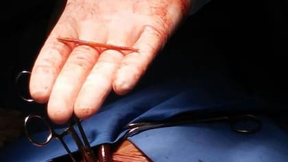 El escarbadientes extirpado
