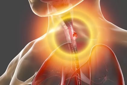 El esófago es el tubo largo que lleva el alimento desde la garganta hasta el estómago. Los principales síntomas del cáncer son tener problemas para tragar, sentir o tener náuseas, acidez estomacal o reflujo, síntomas de indigestión
