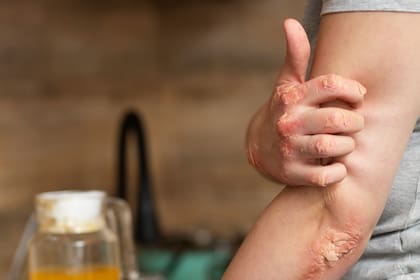 El especialista destacó la importancia del diagnóstico precoz, que permite tratar el cuadro principal y prevenir que esas enfermedades asociadas progresen