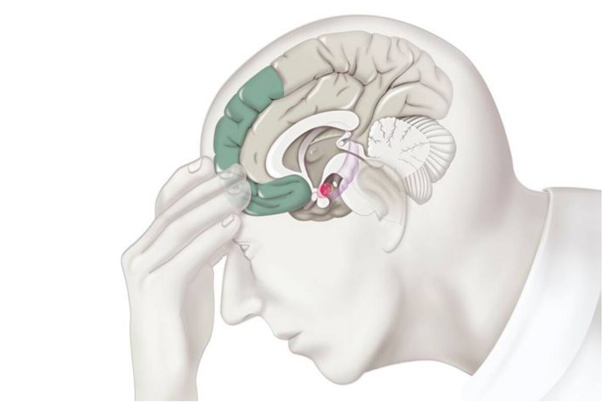 El estrés puede producir cambios en el cerebro responsables de varios trastornos, incluyendo depresión.