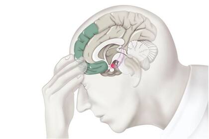 El estrés puede producir cambios en el cerebro responsables de varios trastornos, incluyendo depresión.